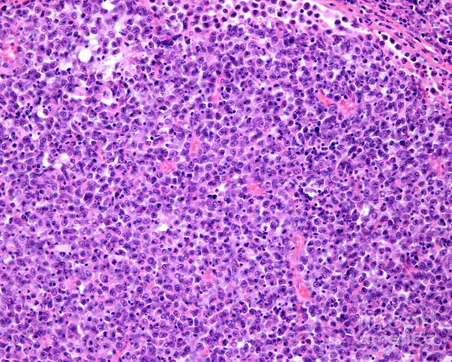 Reticulosarcoma Of The Lymph Node Photograph By Jose Calvo Science