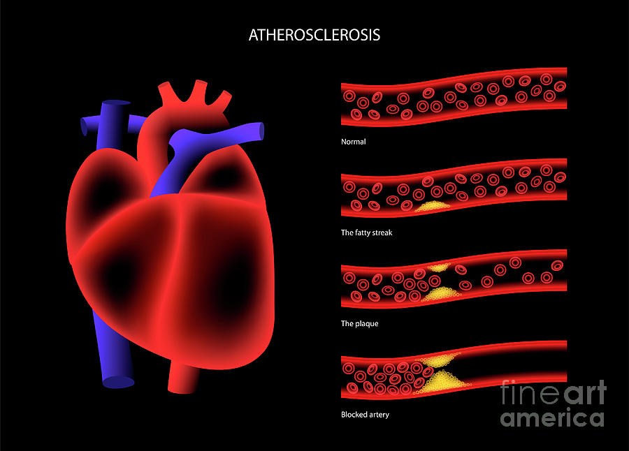 Atherosclerosis Photograph By Pikovit Science Photo Library Pixels