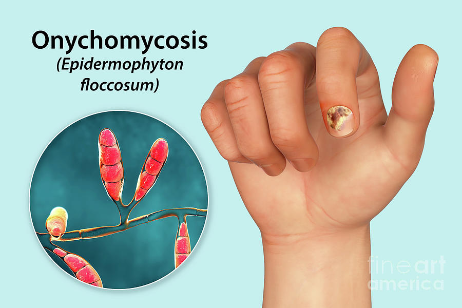 Fungal Nail Infection Photograph By Kateryna Kon Science Photo Library