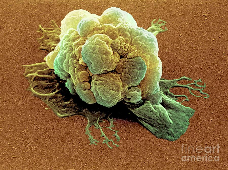 Coloured Sem Of A Breast Cancer Cell Photograph By Steve Gschmeissner