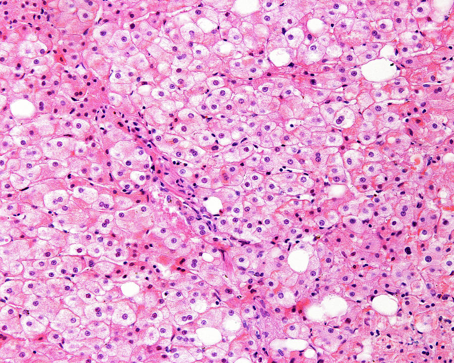 Fatty Liver Disease Photograph By Jose Calvo Science Photo Library