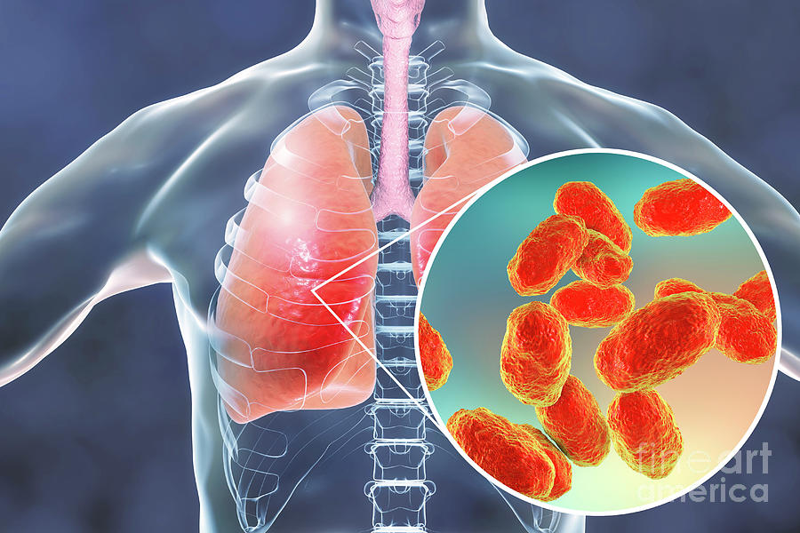 Pneumonia Caused By Haemophilus Influenzae Bacteria Photograph By