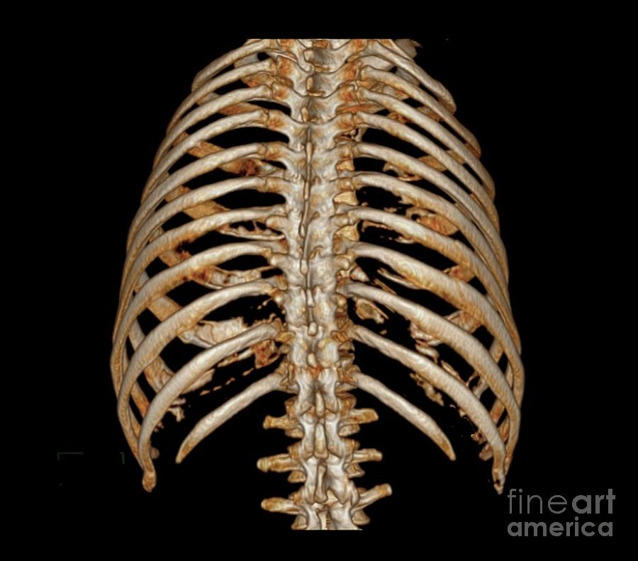 Rib Cage Photograph By Zephyr Science Photo Library Pixels