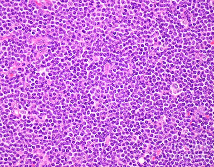 Small Lymphocytic Lymphoma Photograph By Webpathology Science Photo Library