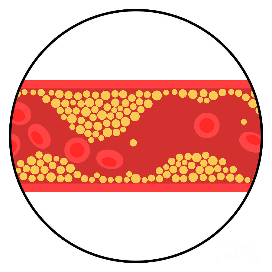 Atherosclerosis By Pikovit Science Photo Library