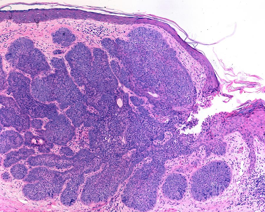 Basal Cell Carcinoma By Jose Calvo Science Photo Library