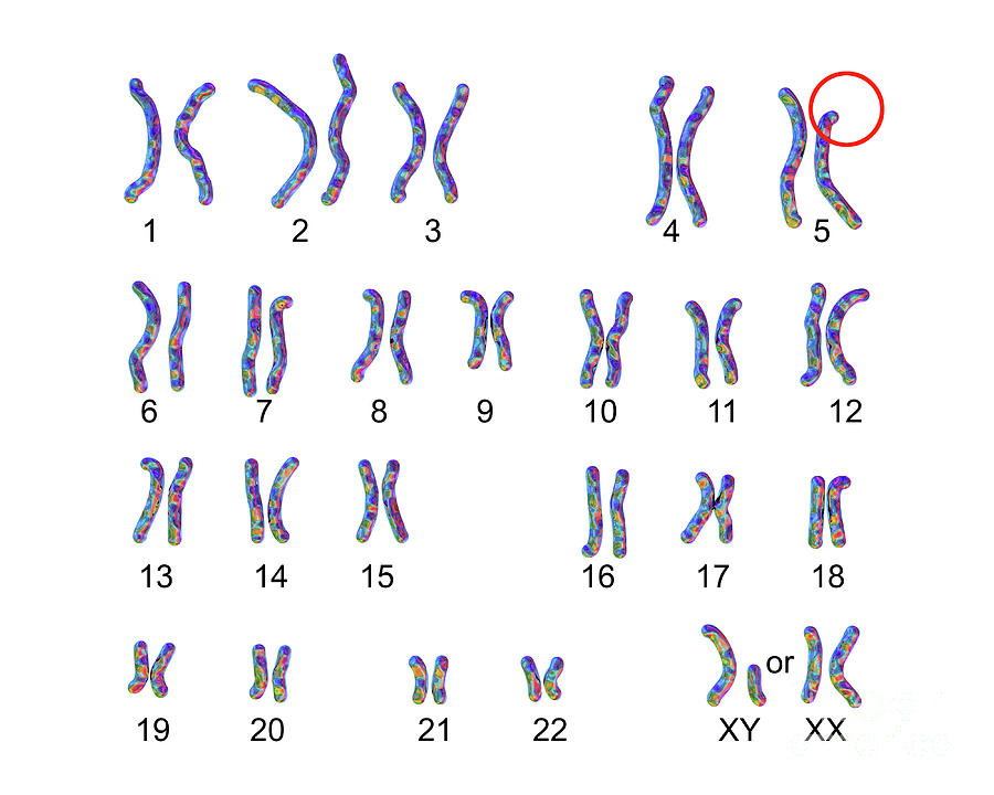 Cri Du Chat Syndrome Karyotype Photograph By Kateryna Kon Science Photo