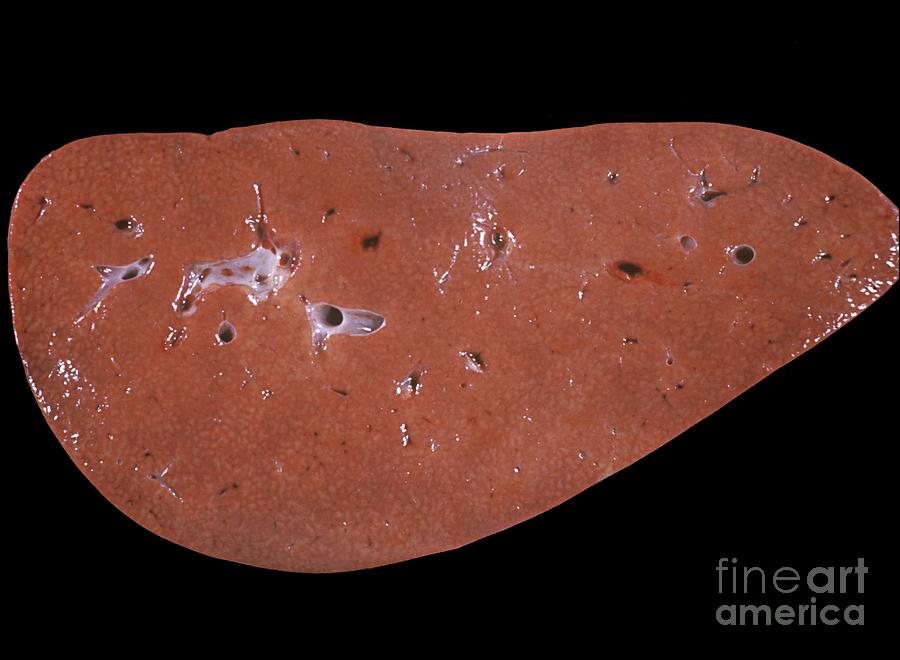 Fatty Liver Disease Photograph By Jose Calvo Science Photo Library