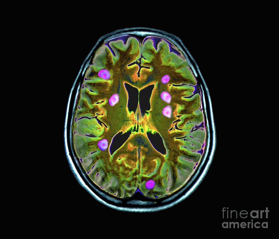 Secondary Brain Cancer Photograph By Zephyr Science Photo Library Pixels