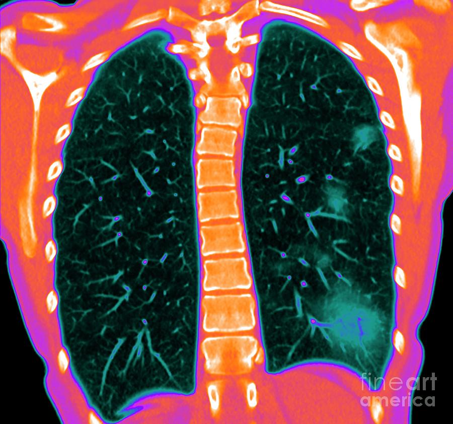 Lungs Affected By Covid 19 Pneumonia Photograph By Vsevolod Zviryk