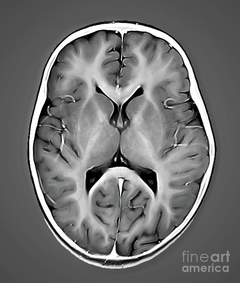 Healthy Brain Photograph By Zephyr Science Photo Library Pixels