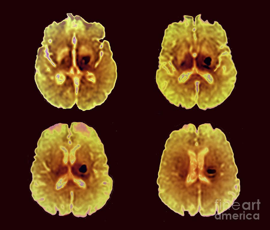 Intracerebral Haemorrhage Photograph By Zephyr Science Photo Library