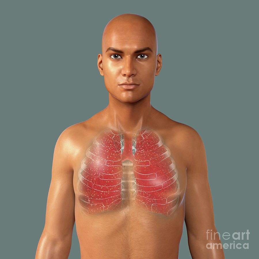 Miliary Tuberculosis Photograph By Kateryna Kon Science Photo Library