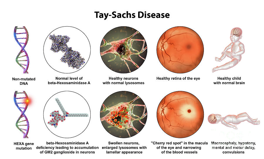 Tay Sachs Disease Photograph By Kateryna Kon Science Photo Library