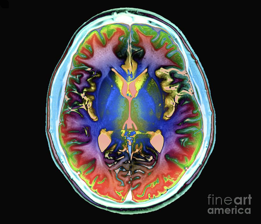 Human Brain By Zephyr Science Photo Library