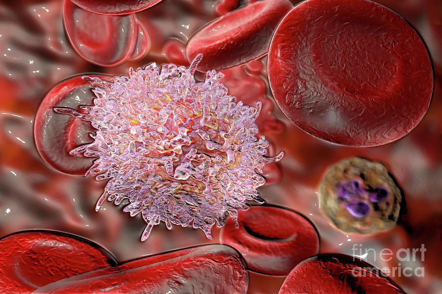 Lymphocyte In Hairy Cell Leukaemia By Kateryna Kon Science Photo Library