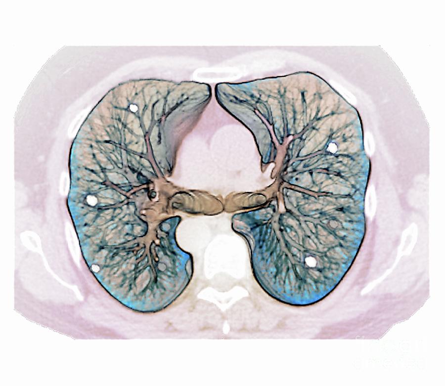 Secondary Lung Cancer Photograph By Zephyr Science Photo Library Pixels