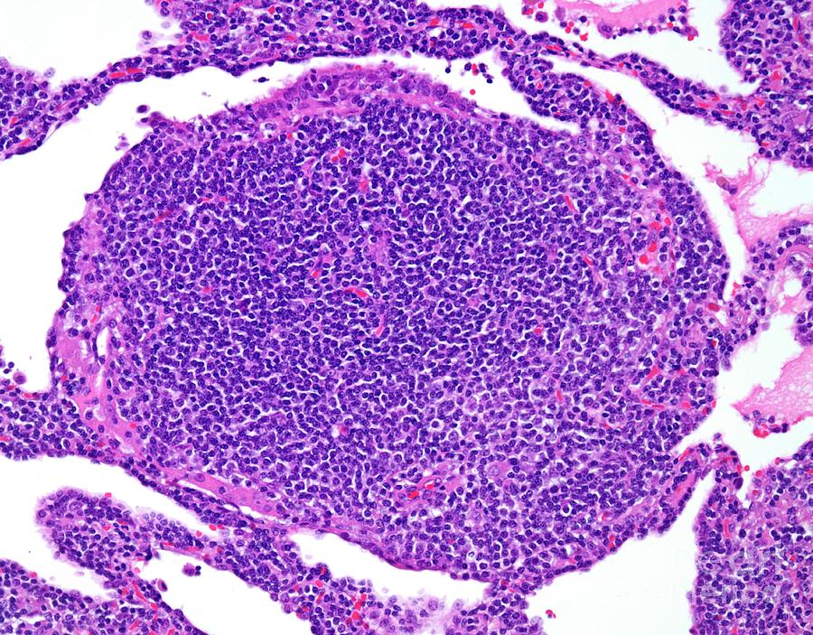 Small Lymphocytic Lymphoma Photograph By Webpathology Science Photo Library