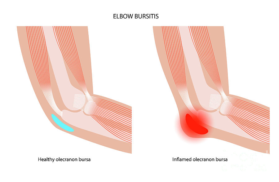 Elbow Bursitis Photograph By Pikovit Science Photo Library Pixels