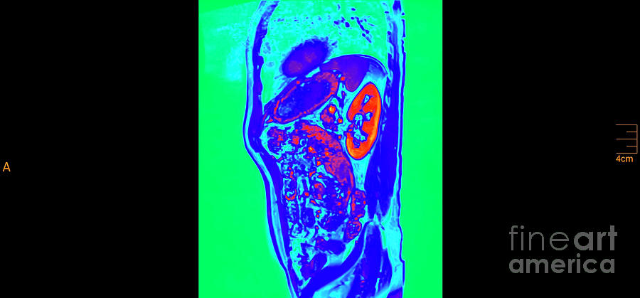 Abdomen Mri Scan Q Photograph By Ilan Rosen Fine Art America