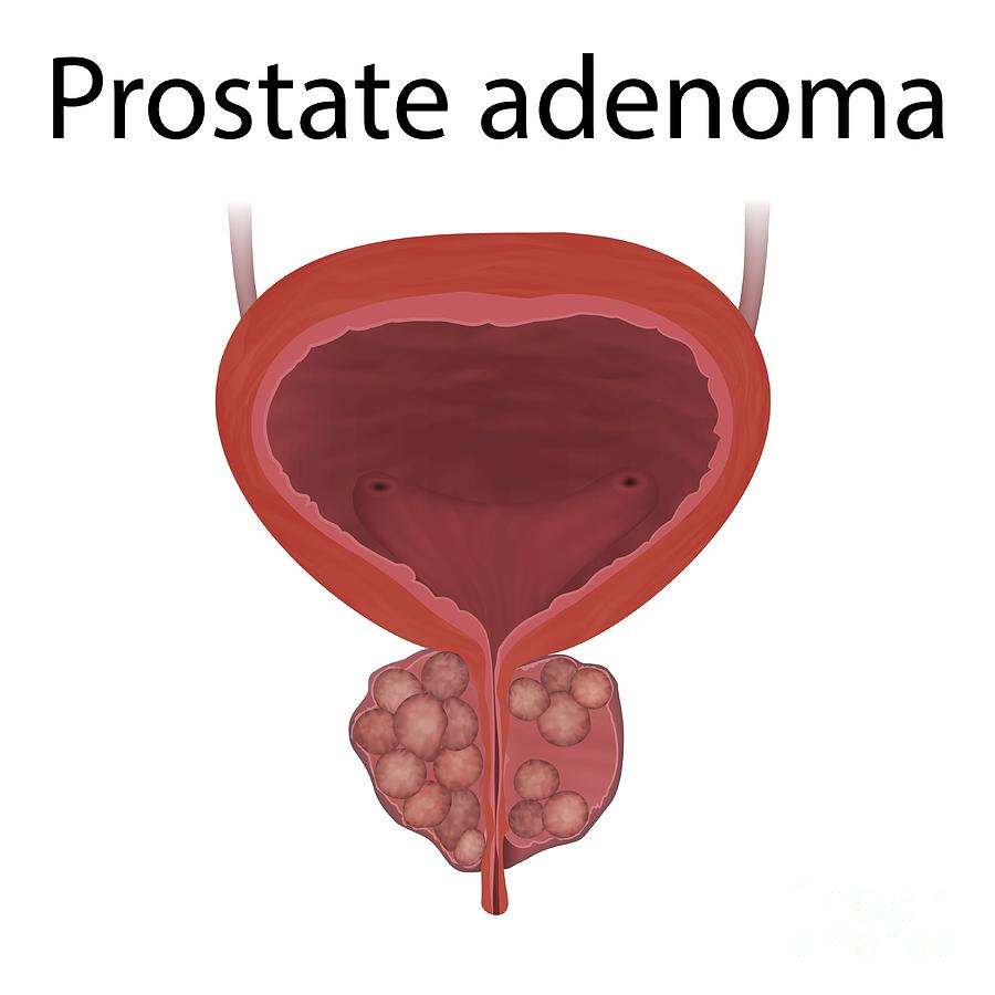 Adenoma Of The Prostate Gland Photograph By Veronika Zakharova Science