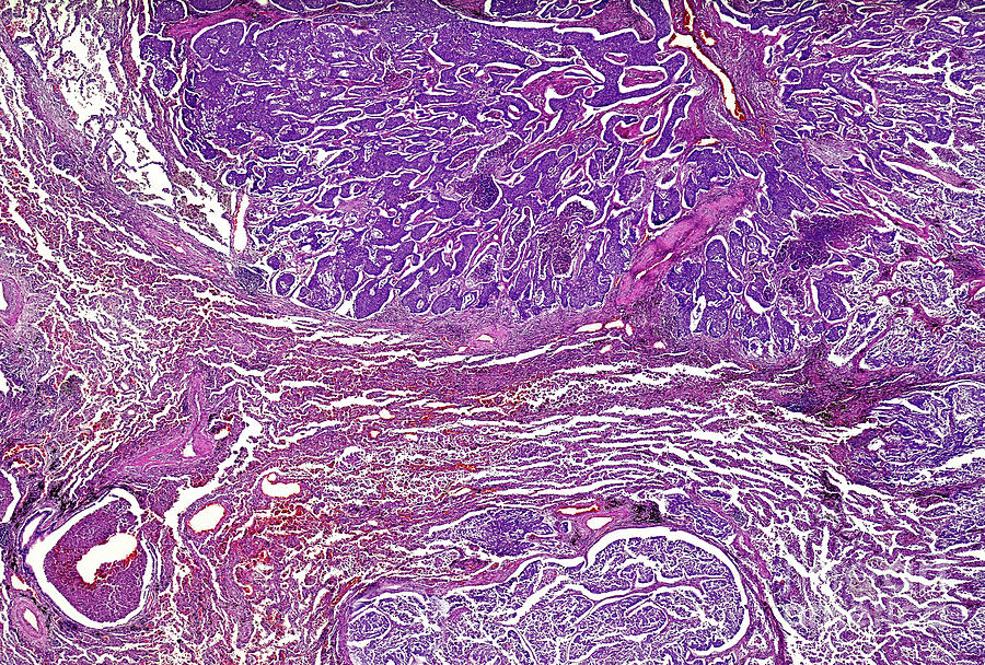 Adenosquamous Carcinoma Of The Lung Photograph By Nigel Downer Science