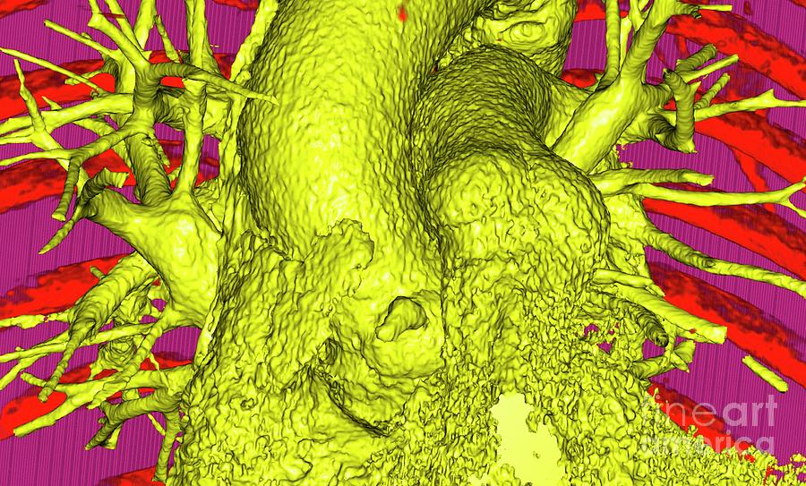 Aorta And Pulmonary Artery Photograph By Vsevolod Zviryk Science Photo