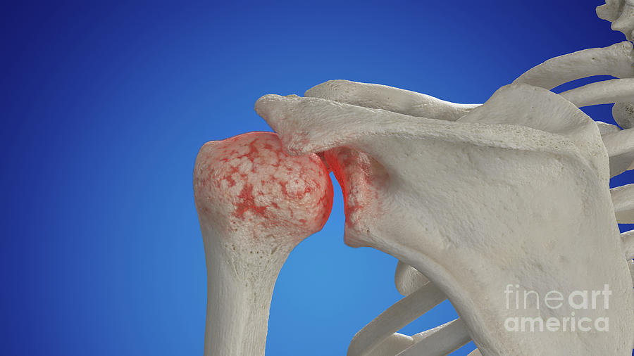 Arthritic Shoulder Joint Photograph By Sebastian Kaulitzki Science