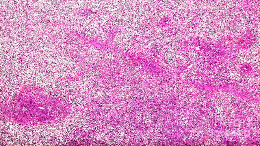 Banti S Disease Of The Spleen Photograph By Nigel Downer Science Photo