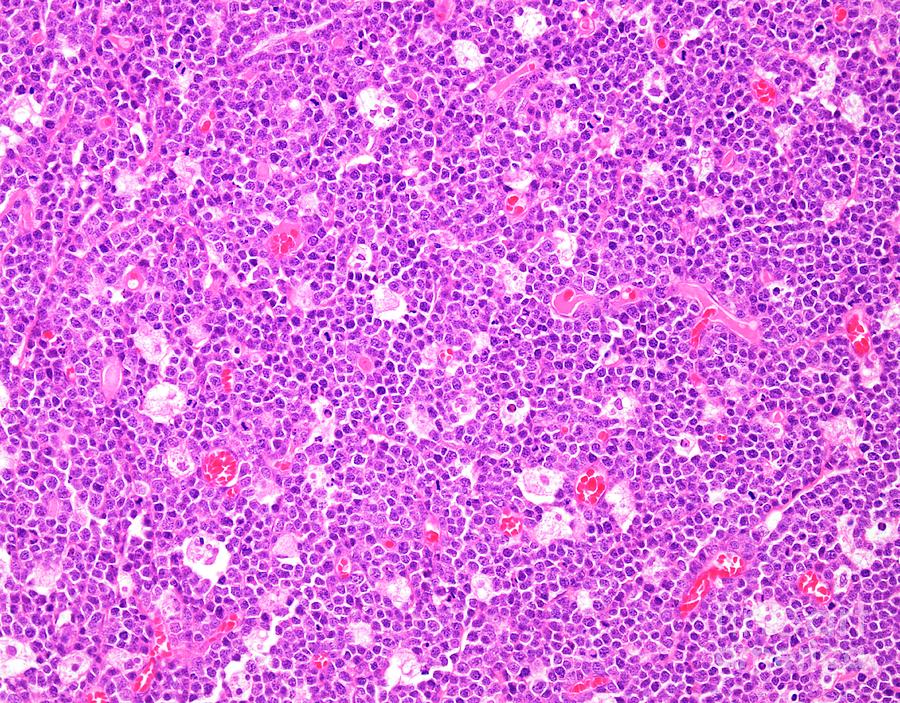 Burkitt S Lymphoma Photograph By Webpathology Science Photo Library