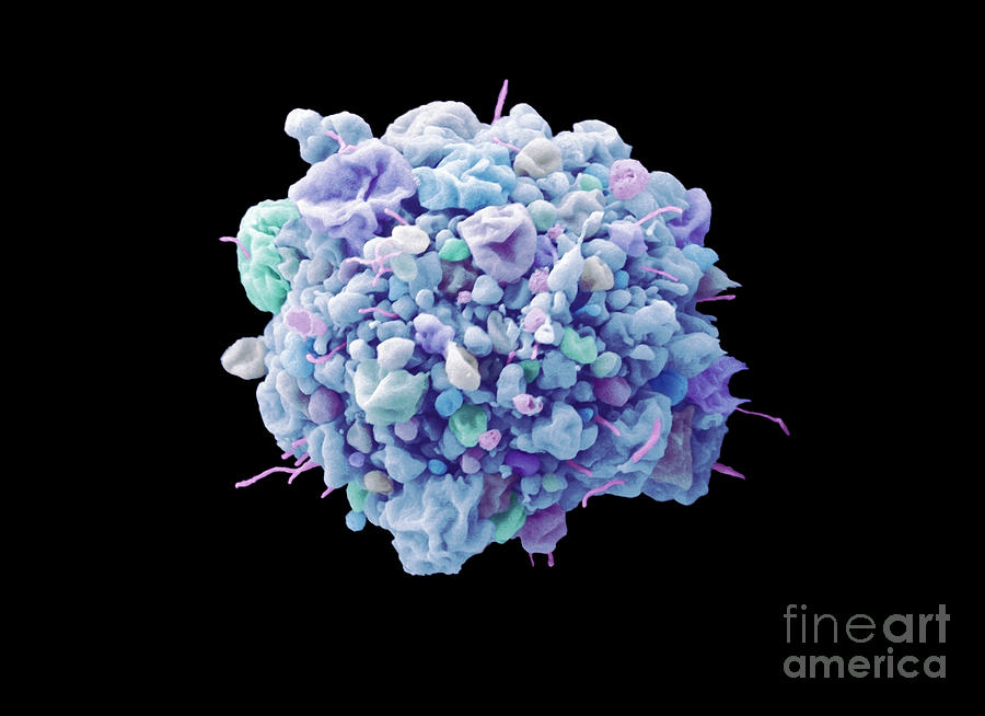 Cervical Cancer Cell Apoptosis By Anne E Weston Science Photo Library