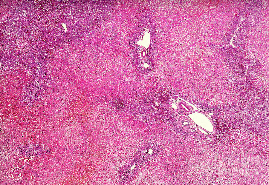 Chronic Hepatic Congestion Of The Liver Photograph By Nigel Downer