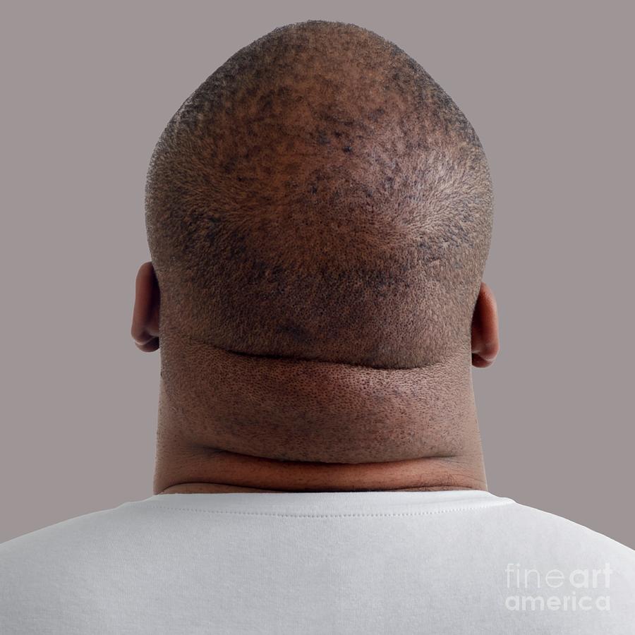 Close Up Of Overweight Man S Neck Photograph By Science Photo Library