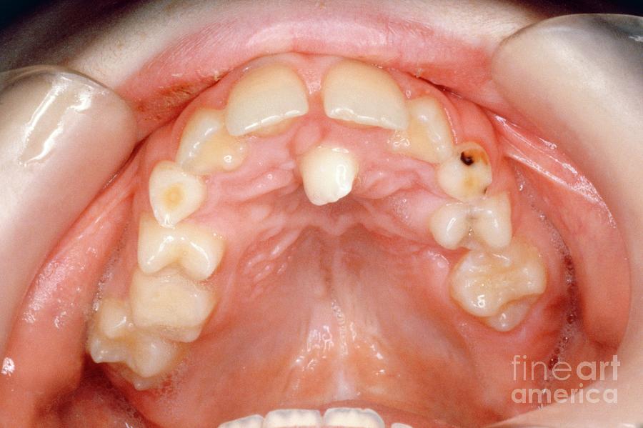 Ectopic Dental Eruption Photograph By Clinica Claros Science Photo