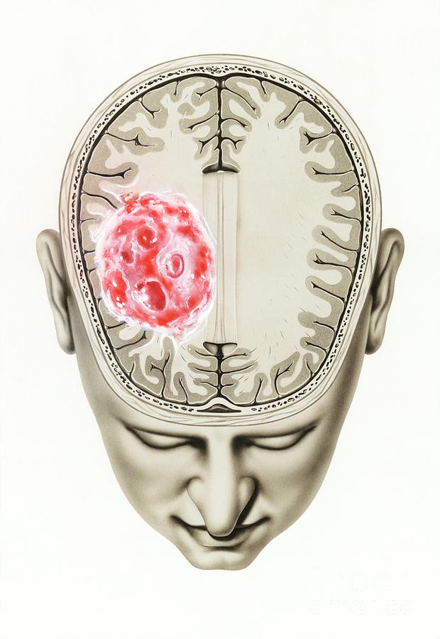 Glioma Brain Tumour Photograph By John Bavosi Science Photo Library