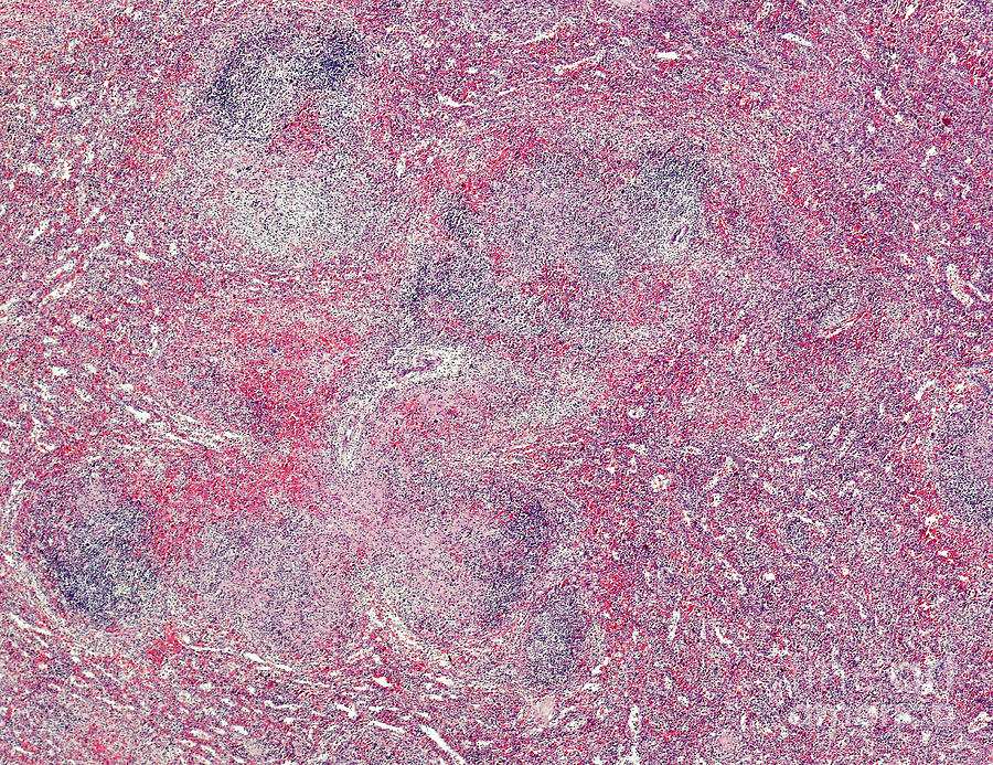 Hodgkin S Lymphoma Of The Spleen By Nigel Downer Science Photo Library