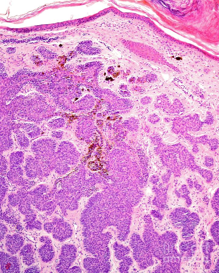 Human Basal Cell Carcinoma By Jose Calvo Science Photo Library