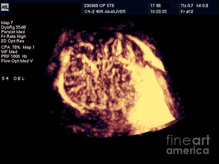 Liver Tumour Photograph By Simon Fraser Science Photo Library Fine