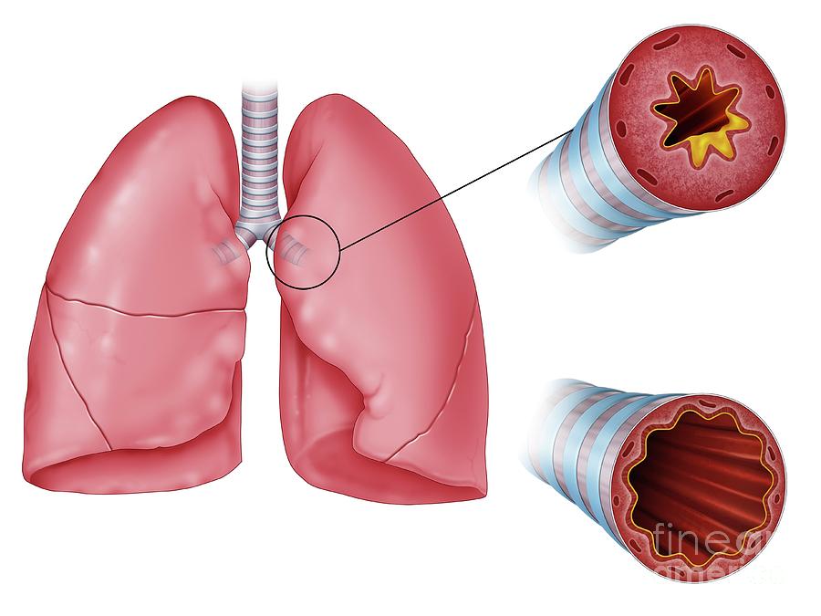 Lung Airway Inflammation Photograph By Maurizio De Angelis Science