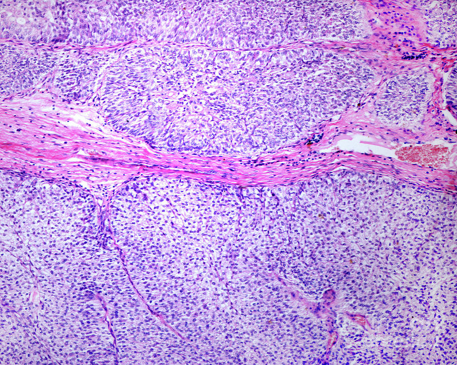 Papillary Carcinoma Of The Bladder Photograph By Jose Calvo Science