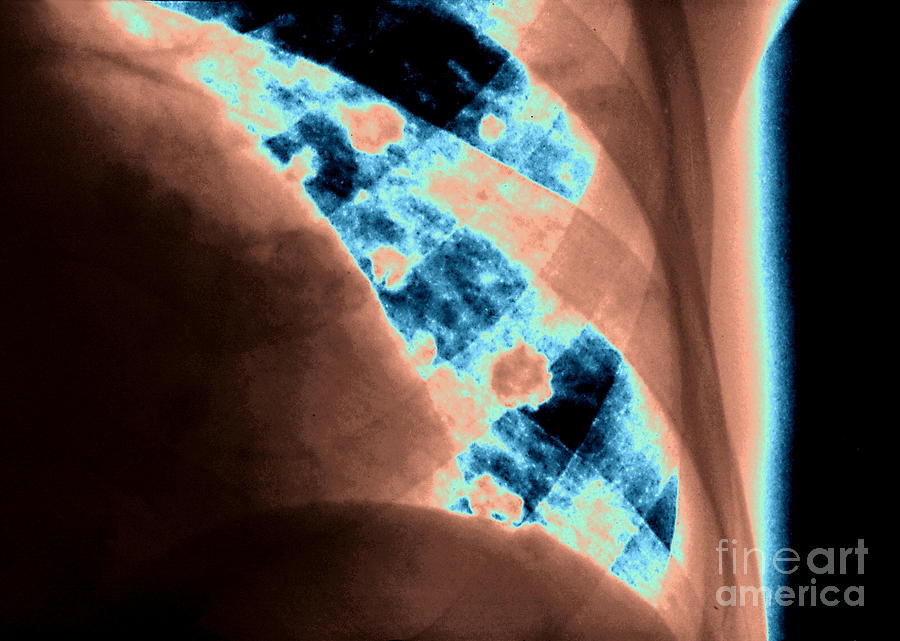 Porocephaliasis Lung Infection Photograph By Zephyr Science Photo Library