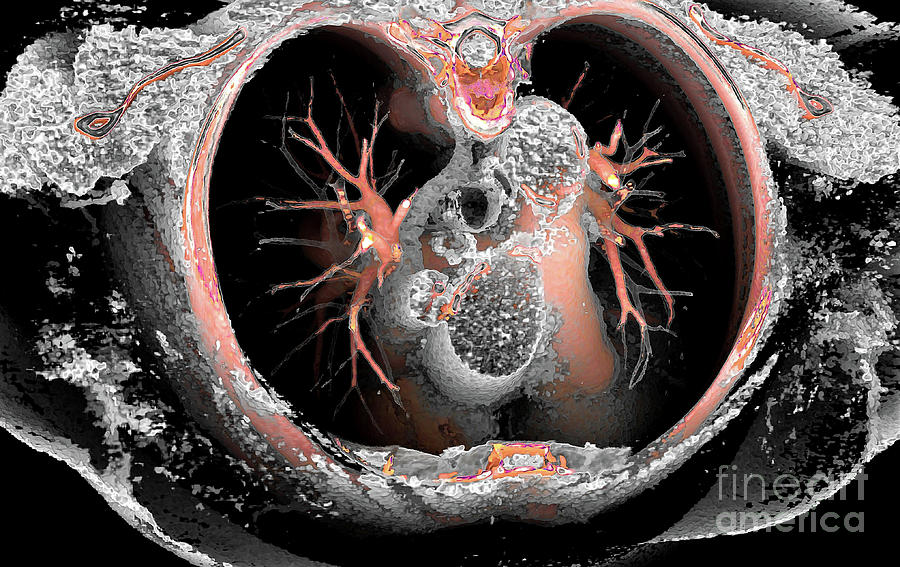 Pulmonary Artery Photograph By Vsevolod Zviryk Science Photo Library