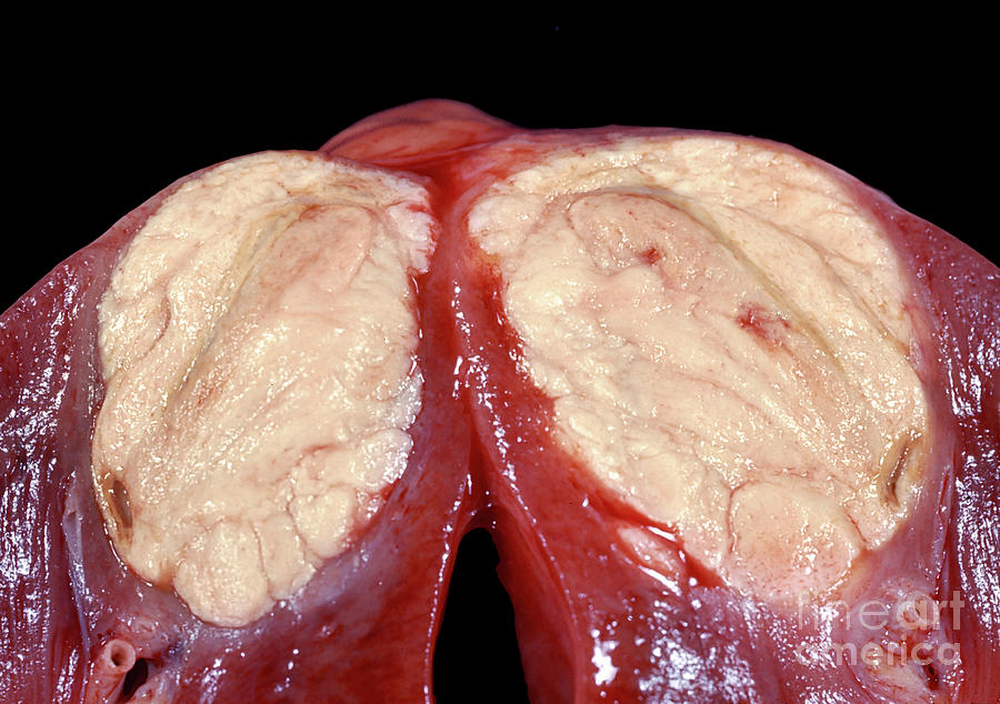 Renal Cell Carcinoma By Jose Calvo Science Photo Library