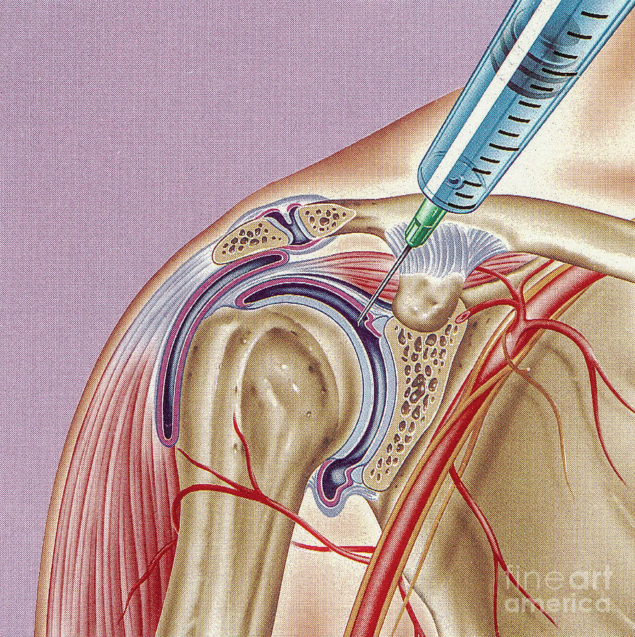 Steroid Treatment Of Shoulder Joint Photograph By John Bavosi Science