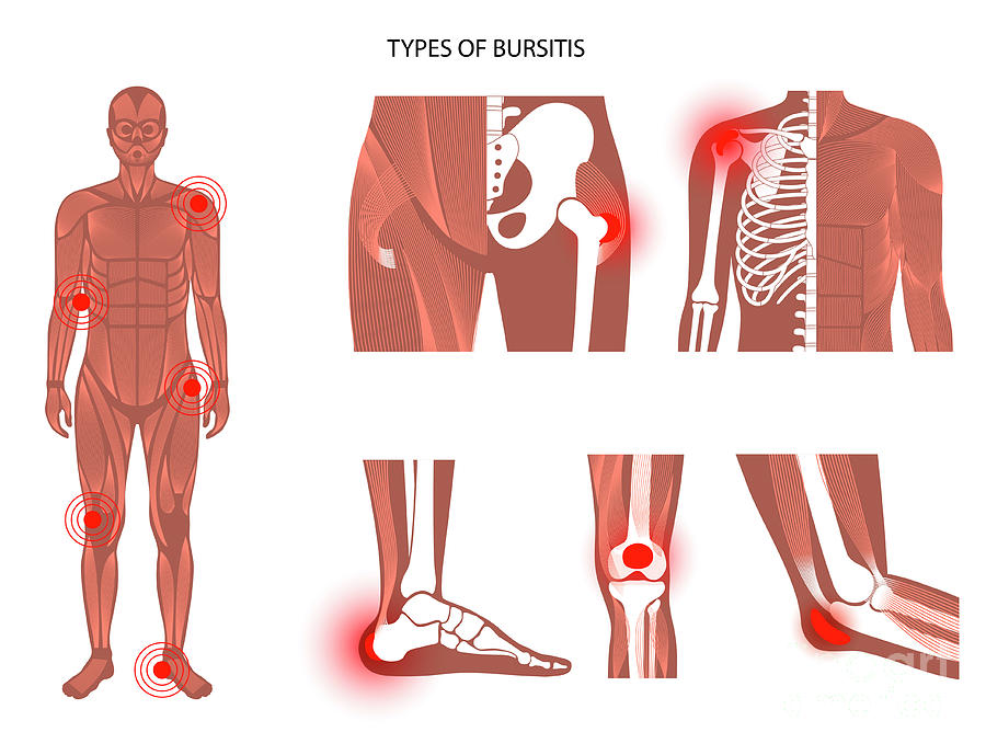 Types Of Bursitis By Pikovit Science Photo Library