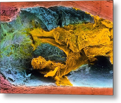 Professor P.m. Motta, G. Macchiarelli, S.a Nottola - Colour Sem Of Atheroscler... Print Professor P.m. Motta, G. Macchiarelli, S.a Nottola - Colour Sem Of Atheroscler... Print