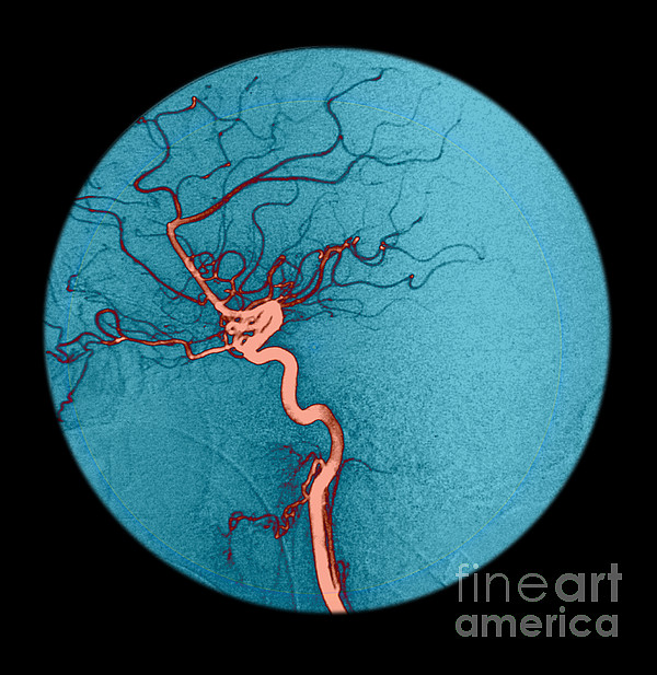 internal carotid artery angiogram