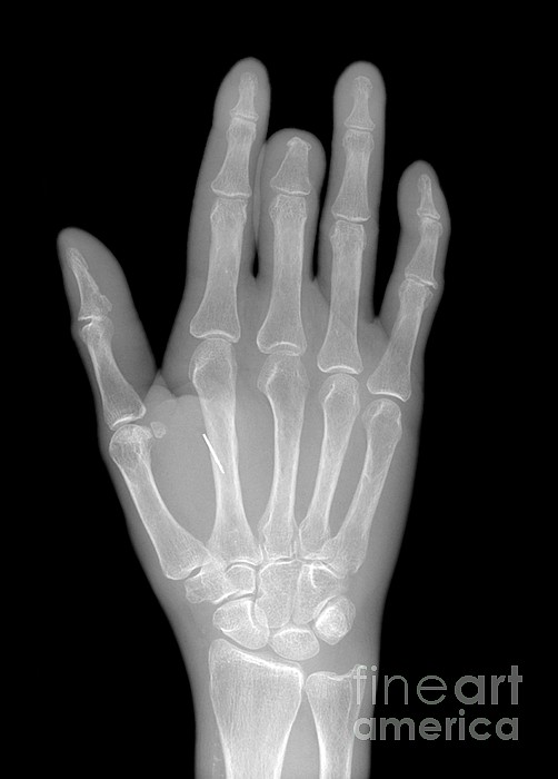 Needle Stuck In Hand, X-ray by Du Cane Medical Imaging Ltd.