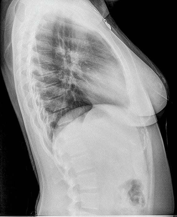 Normal chest radiograph - female, Radiology Case