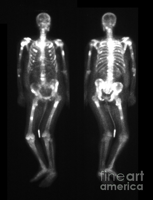 https://images.fineartamerica.com/images-medium-5/8-bone-scan-showing-multiple-metastases-scott-camazine.jpg